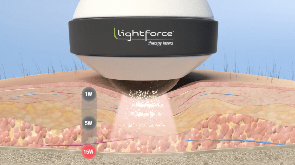 Laser Forum &ndash; Part 1: Understanding Terms That Describe Photobiomodulation (PBM)
