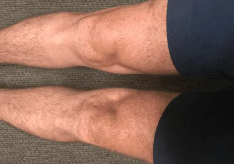 Reflection on &ldquo;Actively&rdquo; Rehabbing after Medial Meniscectomy