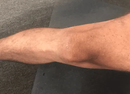 Reflection on &ldquo;Actively&rdquo; Rehabbing after Medial Meniscectomy