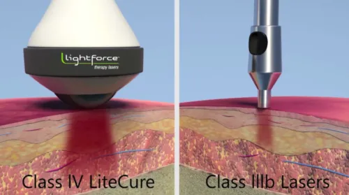 Class IV LiteCure vs. Class IIIb Lasers