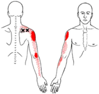 Trigger Points Image